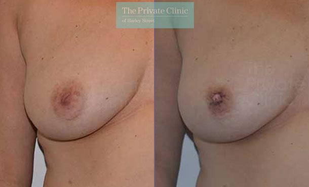 inverted nipples surgery before after photo results front Adrian Richards 035AR