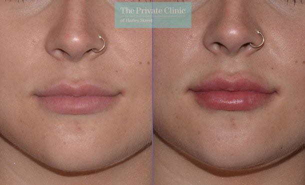 Dermal Filler - Lips - 001CR-Front