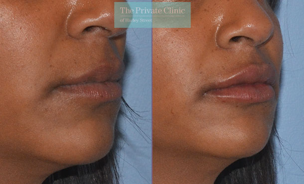 Dermal Filler - Lips - 008MR