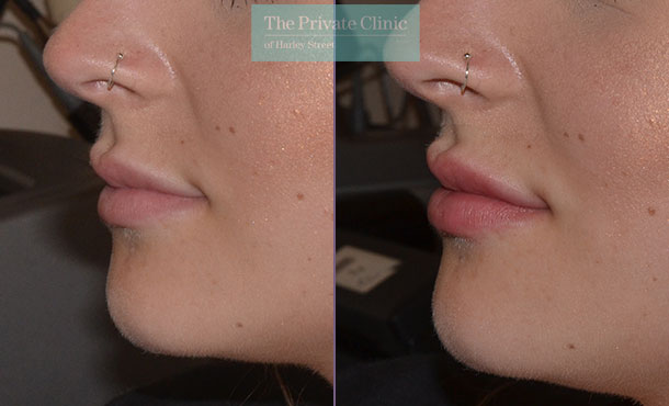 Dermal Filler - Lips - 001CR-Side