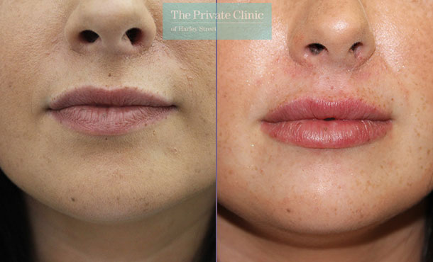 Dermal Fillers - Lips - 003SC-Front