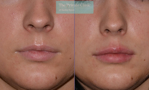 Dermal Filler - Lips - 002MR