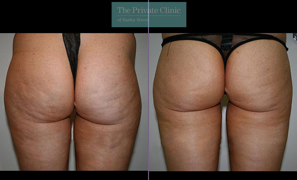 before and after photo of vaser lipo