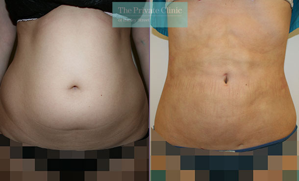 before and after photos of vaser lipo