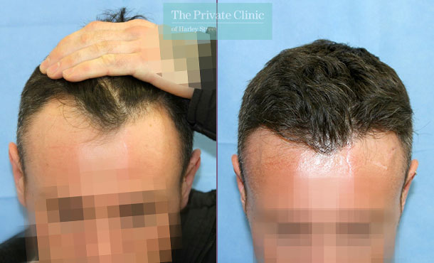 FUE Hair Transplant - 123RR