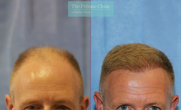 FUE Hair Transplant - 109RR-Front