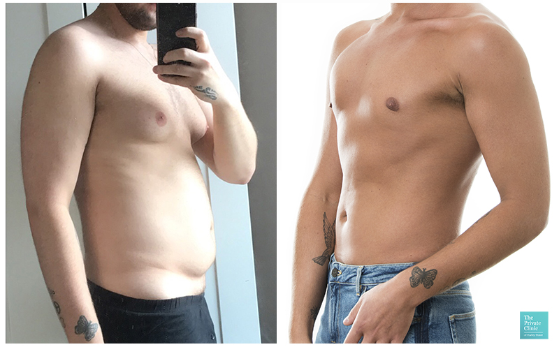 male breast liposuction gynaecomastia men moobs chest reduction before after photo