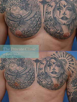 Male Chest Reduction - Gynecomastia Surgery UK, Breast liposuction Men