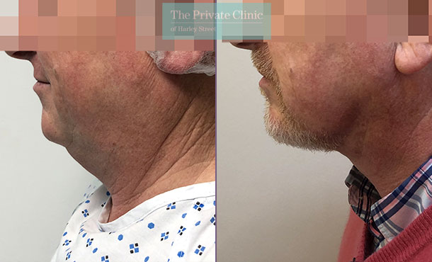 male-double-chin-liposuction-fat-removal-micro-lipo-before-after-photos-results-mr-roberto-uccellini-027RU