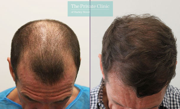 FUE Hair Transplant - 071RR-Crown