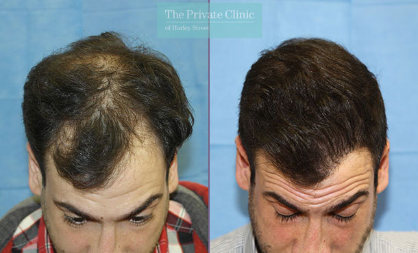 FUE Hair Transplant - 102RR-Front