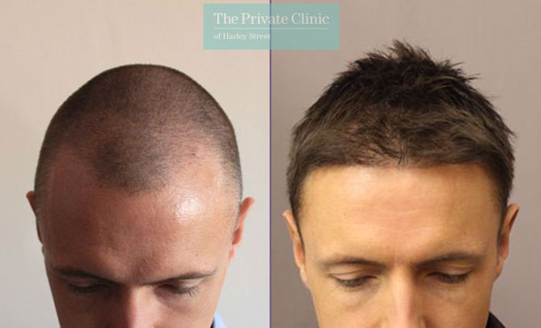 FUE Hair Transplant - 038RR