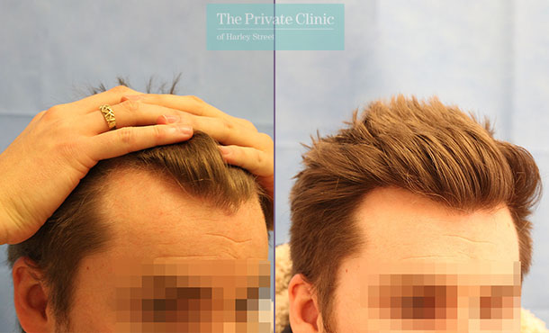 FUE Hair Transplant - 073RR