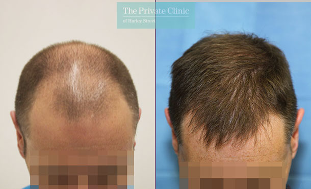 FUE Hair Transplant - 106RR-Front