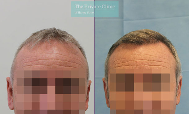 FUE Hair Transplant - 085RR-Front