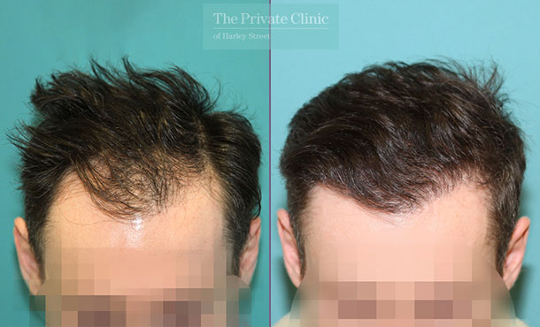 FUE Hair Transplant - 117RR