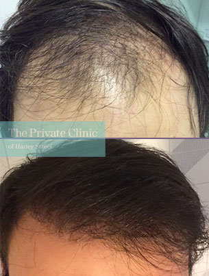 male hair transplant uk fue before after photo results dr luca de fazio 006LDF