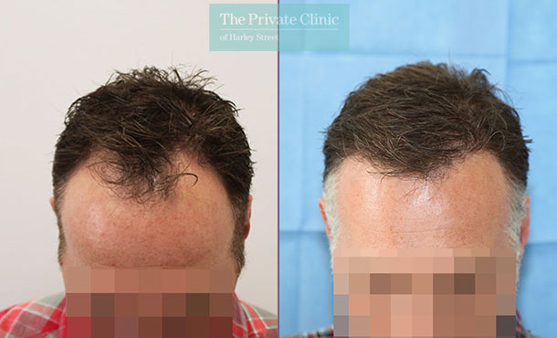 FUE Hair Transplant - 104RR