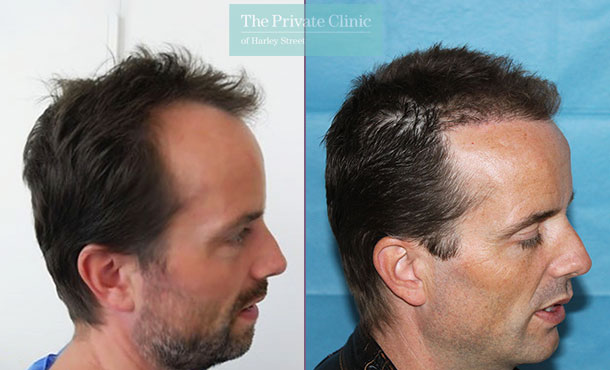 FUE Hair Transplant - 022RR-Side