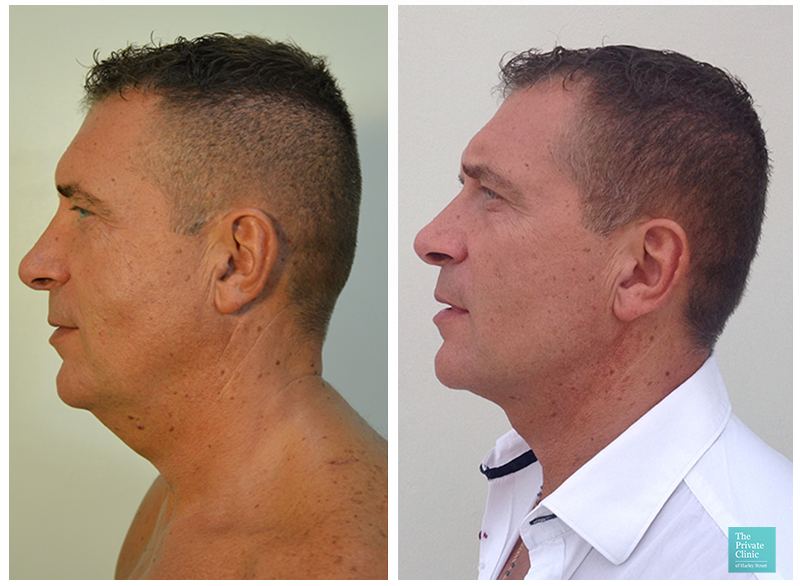 male liposuction double chin neck men before after photo