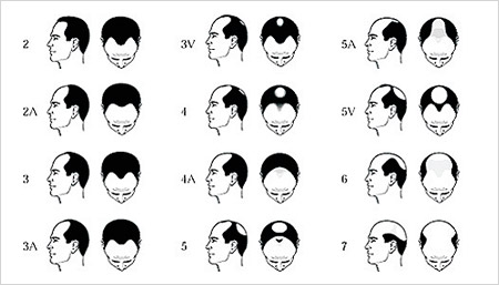 male pattern hairloss norwood scale hair transplant the private clinic