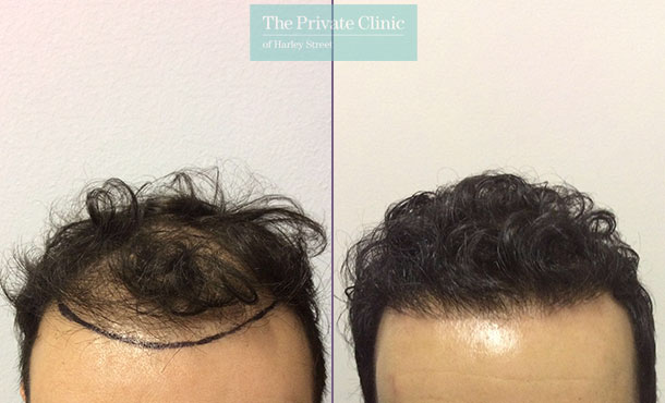 mens fue hair transplant before after photos results dr luca de fazio 008LDF