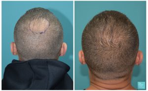 mike thurston hair transplant 6 months results crown transplant hair loss the private clinic 300x186 1