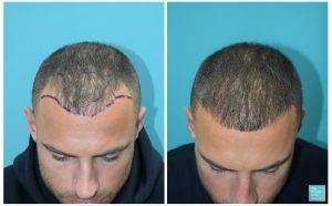 mike thurston hair transplant 6 months results hairline transplant hair loss the private clinic 300x186 1