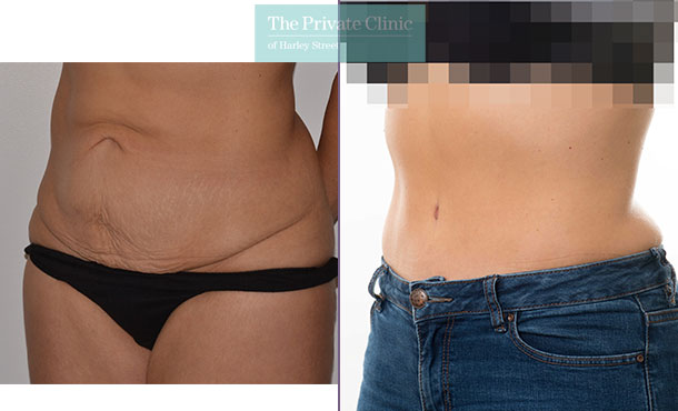 Tummy Tuck / Abdominoplasty - 057AR-Side