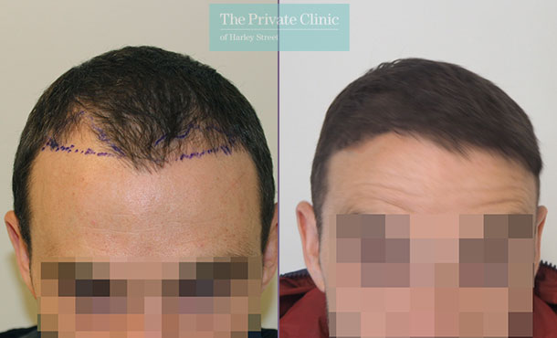 FUE Hair Transplant - 007MM-Front