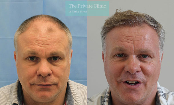 FUE Hair Transplant - 088RR-Front