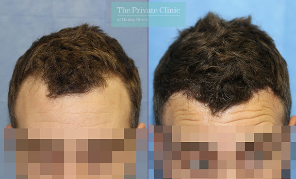 FUE Hair Transplant - 007RR-Front