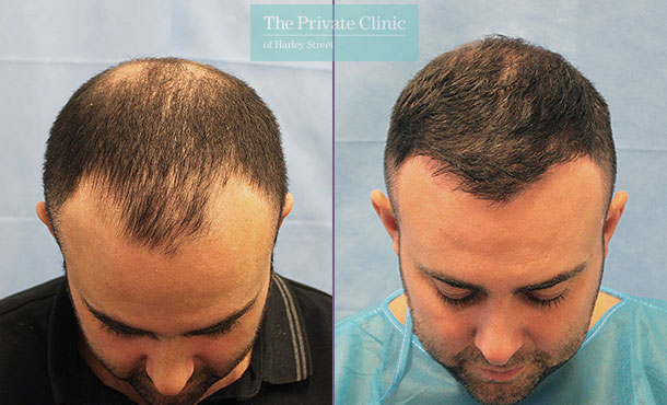 FUE Hair Transplant - 070RR-Crown