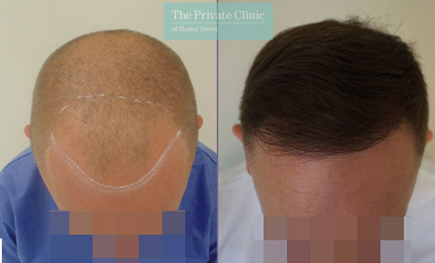 FUE Hair Transplant - 012MM