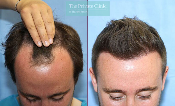 FUE Hair Transplant - 116RR