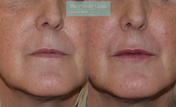 Dermal Filler - Lips - 004MR