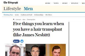 news five things you learn when you have a hair transplant like James Nesbitt the private clinic