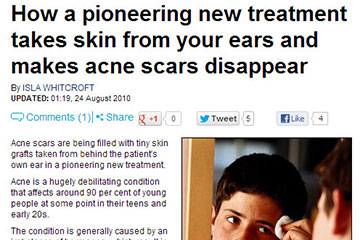 news how a pioneering new treatment takes skin from your ears and makes acne scars disappear the private clinic