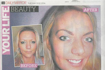 news i had an eyebrow transplant to get the cara look the private clinic