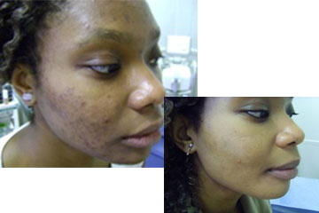 news result driven treatment acne the private clinic