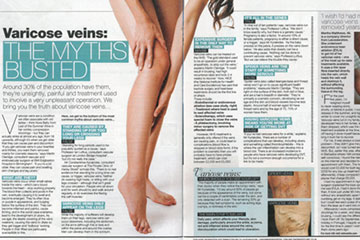 news varicose veins the myths busted the private clinic