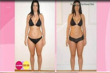 news vaser liposuction patient interview on ITVs Lorraine show the private clinic