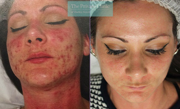 nlite laser acne treatment reviews before after results 018TPC