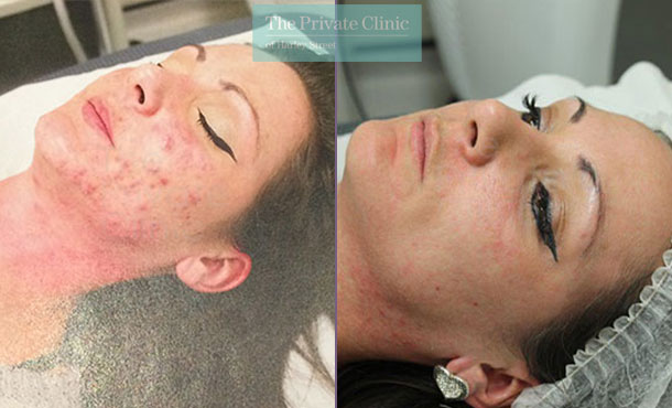 nlite laser acne treatment reviews before after results 022TPC