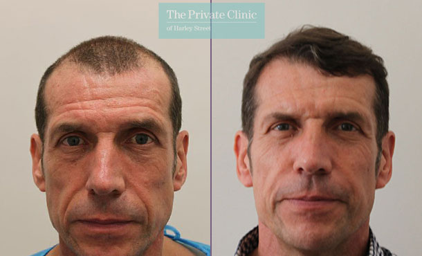 FUE Hair Transplant - 071RR-Front