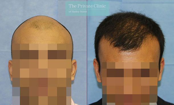 FUE Hair Transplant - 111RR-Front