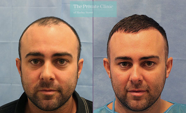 FUE Hair Transplant - 070RR-Front