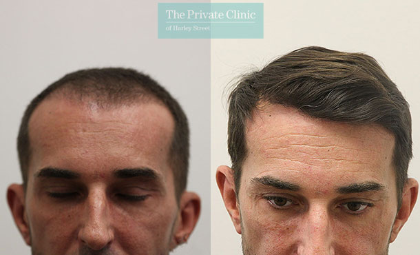 FUE Hair Transplant -062RR