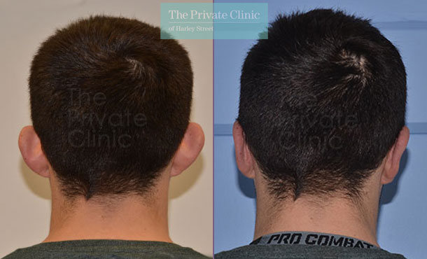 otoplasty ear correction surgery male before after photo results back 014TPC