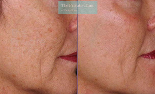 pearl laser resurfacing before after photo results 035TPC